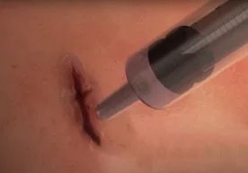1 daqiqa ichida yarani bog‘lab, bitkazadigan tibbiyot yelimi ixtiro qilindi (video) фото
