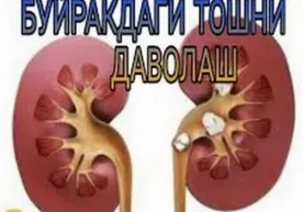 Buyraklardan toshlar va tuzlarni chiqarib yuborishning usullari фото