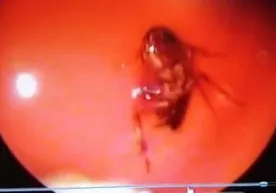 Uxlayotgan qizning qulogʻiga suvarak kirib ketdi (video) фото