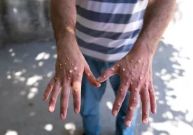 Санэпидқўмита: “Mpox вирусининг Ўзбекистонга кириб келмаслик чоралари кўриляпти” фото
