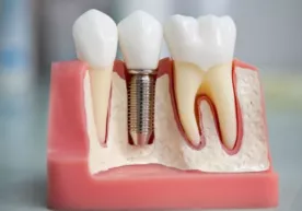 Implant tish qo‘ydirish haqida фото