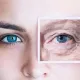 Göz altı kırışıklıkları nasıl giderilir?