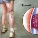 Mutaxassis tromb paydo bo‘lishining sabablari va belgilarini aytdi