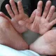 Askaridoz kasalligi haqida nimalarni bilasiz? (foto)