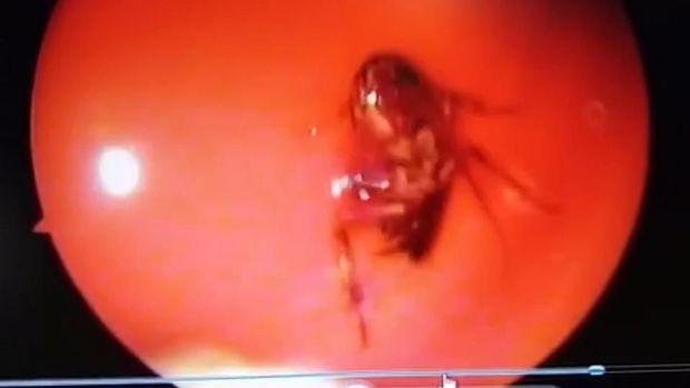 Uxlayotgan qizning qulogʻiga suvarak kirib ketdi (video)