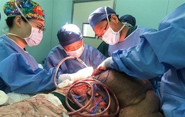 Xitoylik erkakning orqasidagi 15 kg oʻsimtani olib tashlashga bir kundan koʻproq vaqt talab etildi