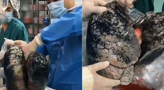 30 yil davomida tamaki chekkan odamning o‘pkasi ko‘rsatildi (video)