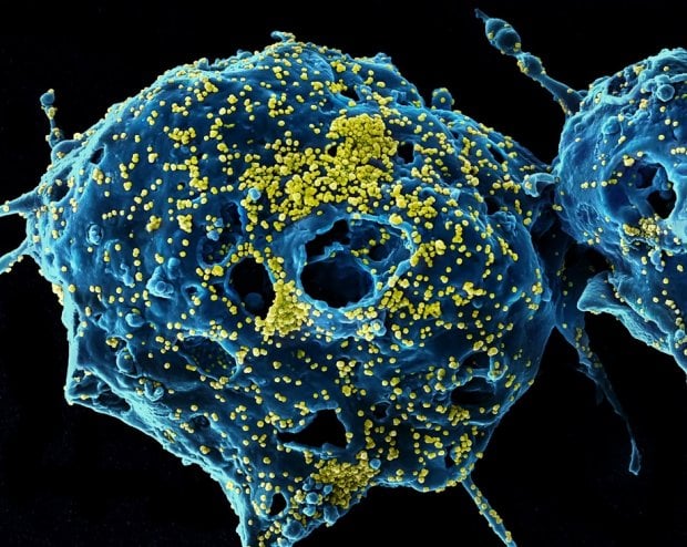 Koronavirus: o‘lim holatining asosiy omillari